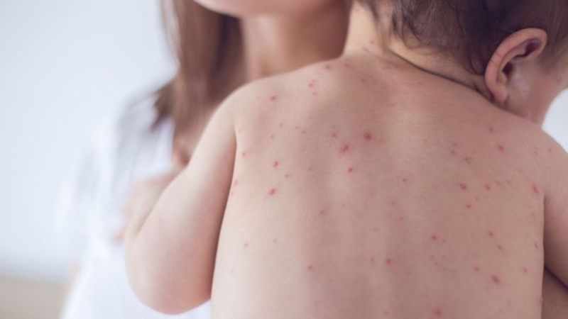 measles-collected-6a9ff3641bddd-6aa13077312c2-2057da5947a4798b97b6b502a74866da1788955999.jpg